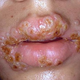 Illustration for article titled Cara Menyembuhkan Penyakit Herpes